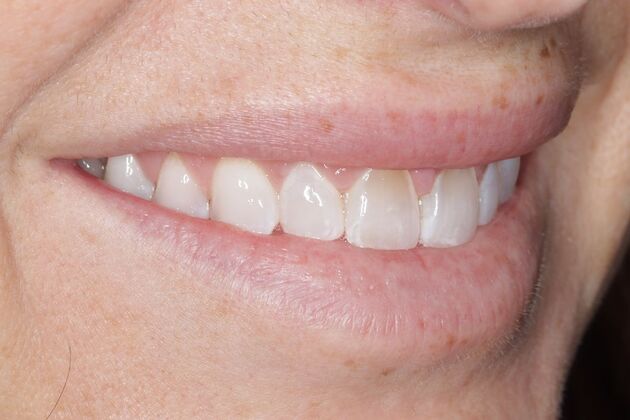 Smile Gallery : Case 1 - Before
