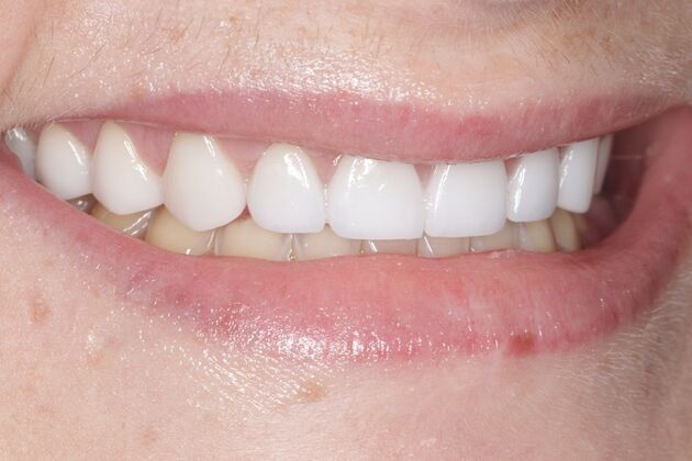 Smile Gallery : Case 2 - After