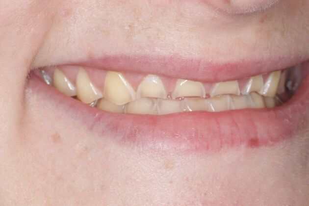 Smile Gallery : Case 2 - Before