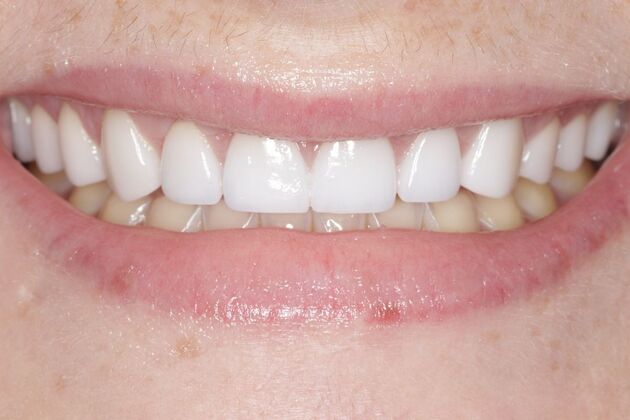 Smile Gallery : Case 2 - After