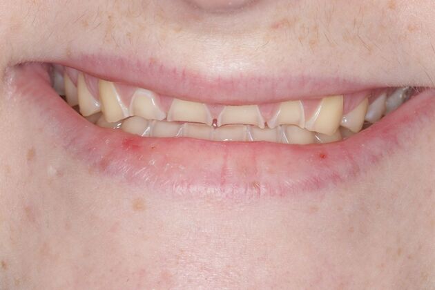 Smile Gallery : Case 2 - Before