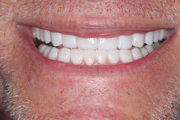 Smile Gallery : Case 3 - After