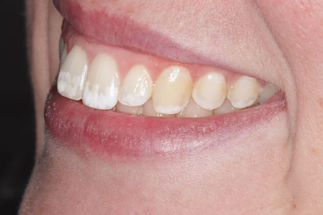 Smile Gallery : Case 4 - Before