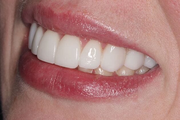 Smile Gallery : Case 4 - After