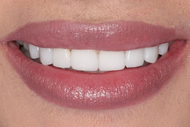 Smile Gallery : Case 5 - After