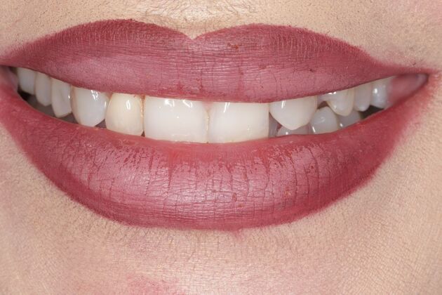Smile Gallery : Case 5 - Before
