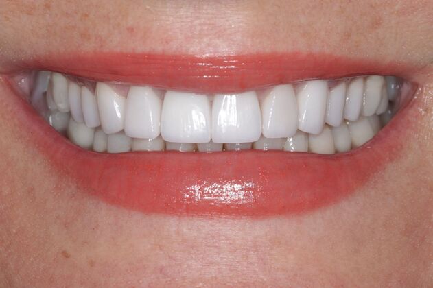 Smile Gallery : Case 6 - After