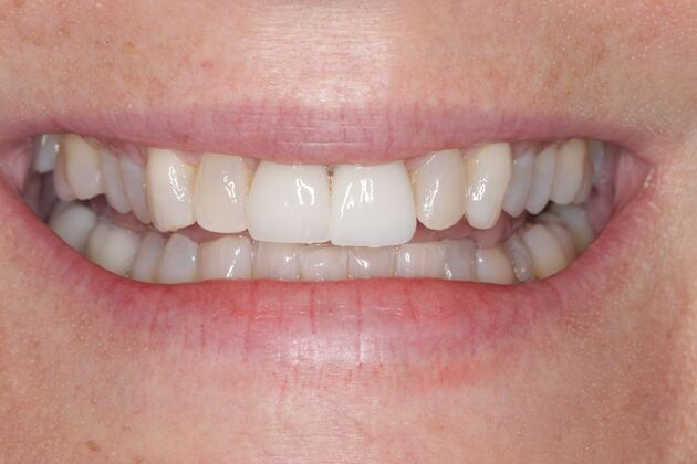 Smile Gallery : Case 6 - Before