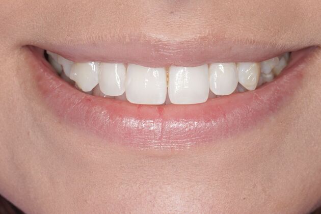 Smile Gallery : Case 7 - Before