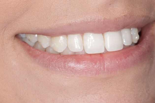 Smile Gallery : Case 7 - Before