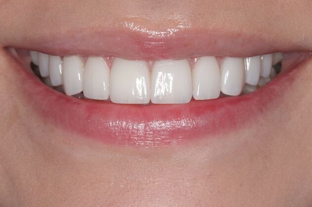 Smile Gallery : Case 7 - After