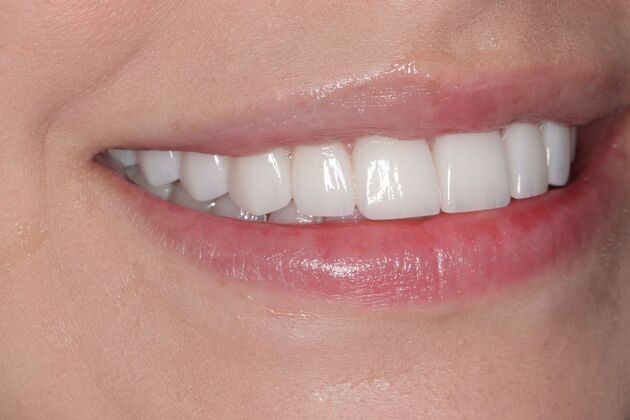 Smile Gallery : Case 7 - After