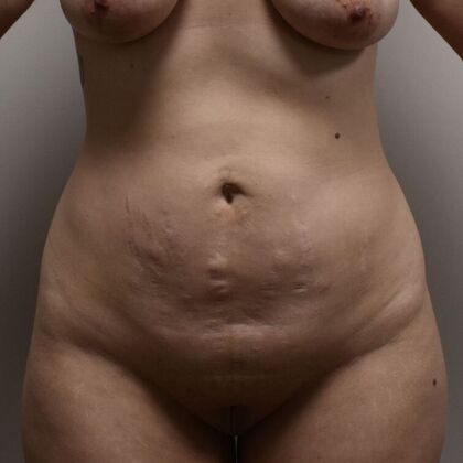 Tummy Tuck (Abdominoplasty) Case 551 - Before