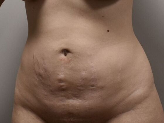 Tummy Tuck (Abdominoplasty): Case 551 - Before