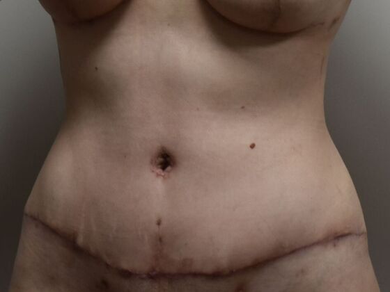 Tummy Tuck (Abdominoplasty): Case 551 - After