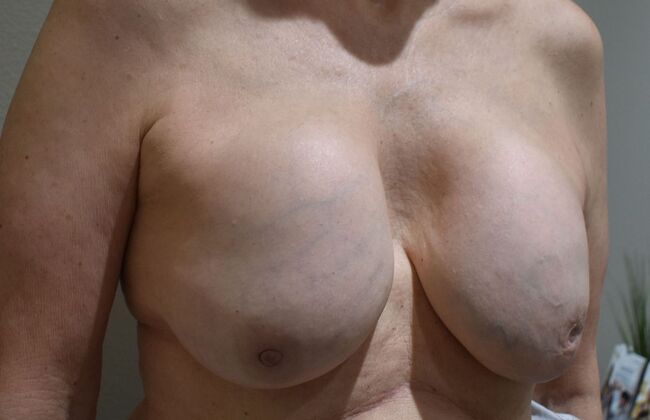 Breast Implant Removal: Case 60 - Before