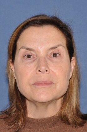 Facelift: Lovely patient after Deep Plane Face and Neck Lift - Before