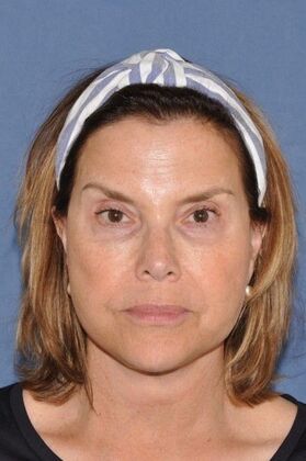 Facelift: Lovely patient after Deep Plane Face and Neck Lift - After