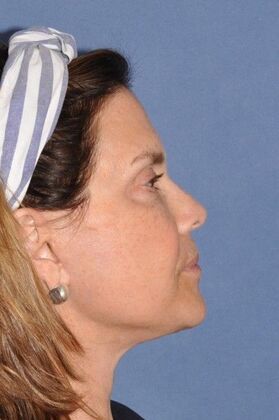 Facelift: Lovely patient after Deep Plane Face and Neck Lift - After
