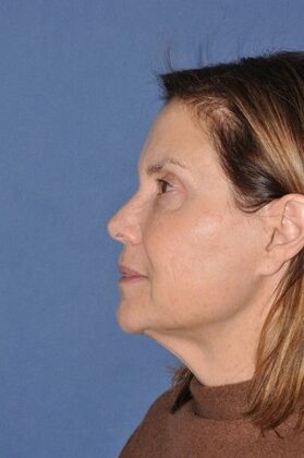 Facelift: Lovely patient after Deep Plane Face and Neck Lift - Before