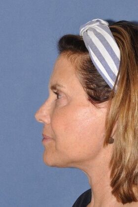 Facelift: Lovely patient after Deep Plane Face and Neck Lift - After