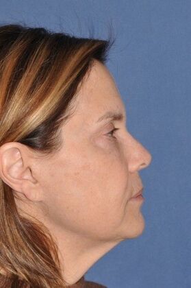 Facelift: Lovely patient after Deep Plane Face and Neck Lift - Before