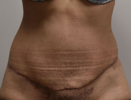 Tummy Tuck (Abdominoplasty) Case 552 - After