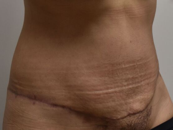 Tummy Tuck (Abdominoplasty): Case 552 - After