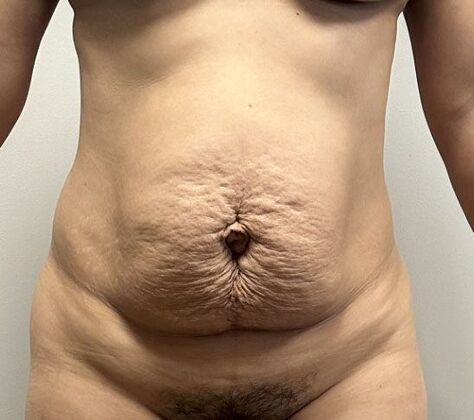 Tummy Tuck (Abdominoplasty): Case 552 - Before