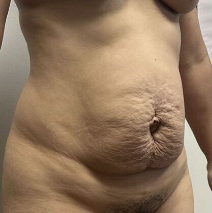 Tummy Tuck (Abdominoplasty): Case 552 - Before