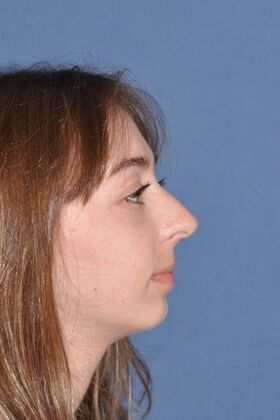 Rhinoplasty: Rhinoplasty with tip sutures - Before