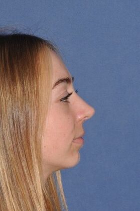 Rhinoplasty: Rhinoplasty with tip sutures - After