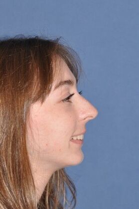 Rhinoplasty: Rhinoplasty with tip sutures - Before