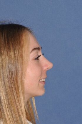 Rhinoplasty: Rhinoplasty with tip sutures - After