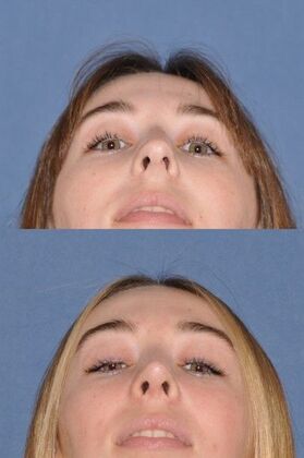 Rhinoplasty: Rhinoplasty with tip sutures - Before