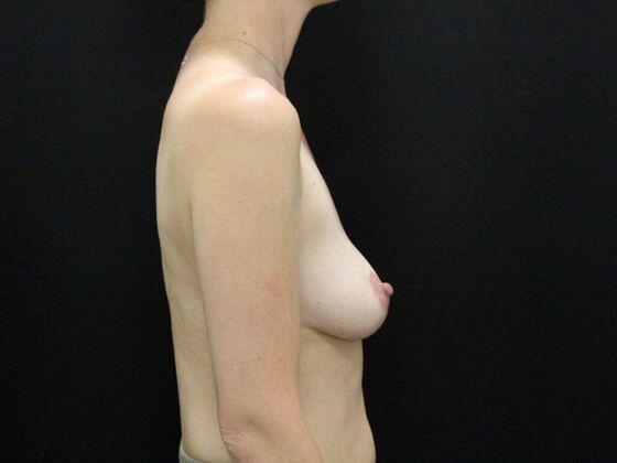 Breast Lift & Breast Lift Augmentation: Case 61 - Before