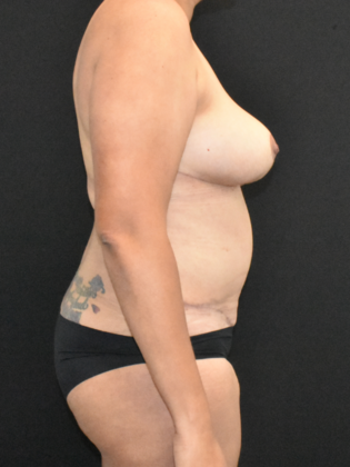 Mommy Makeover: Case 18 - After