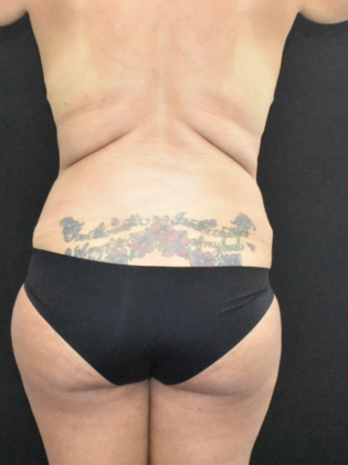 Mommy Makeover: Case 18 - After