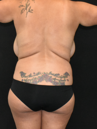 Mommy Makeover: Case 18 - Before