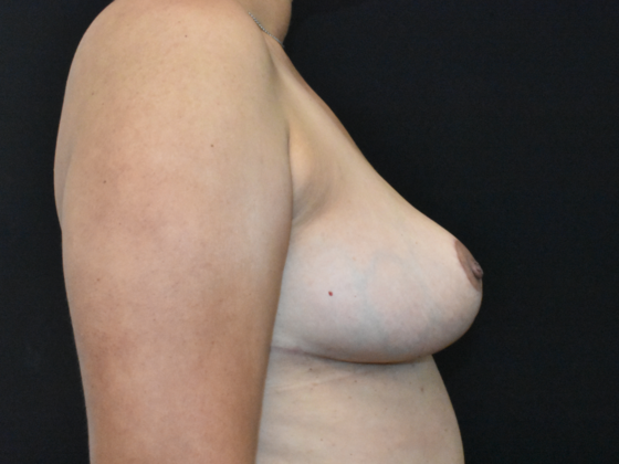 Breast Reduction: Case 11 - Before