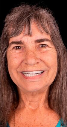 Dental Implants: Lisa - After