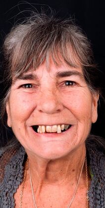 Dental Implants: Lisa - Before