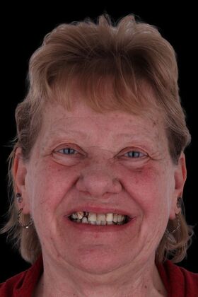 Dental Implants: Nancy - Before