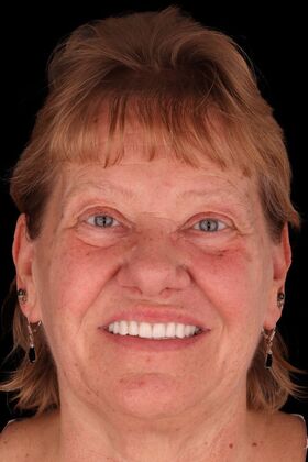 Dental Implants: Nancy - After