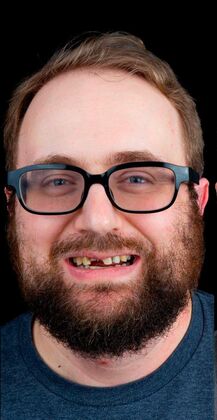 Full Mouth Restoration Jason - Before