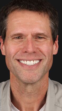 Full Mouth Restoration Larry  - After