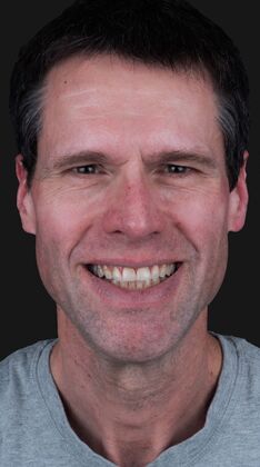 Full Mouth Restoration Larry  - Before