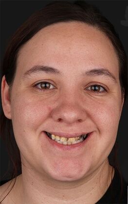 Full Mouth Restoration Miranda - Before