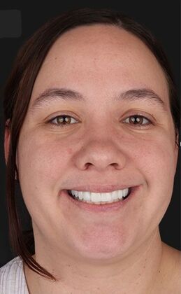 Full Mouth Restoration Miranda - After