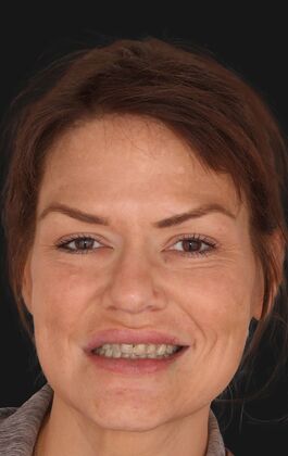 Full Mouth Restoration Sara - Before